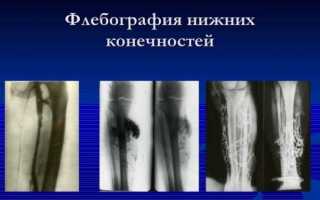 Перфорантная недостаточность вен голени