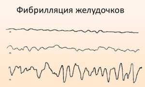 Желудочковая аритмия сердца симптомы лечение