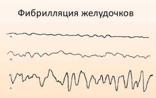 Желудочковая аритмия сердца симптомы лечение