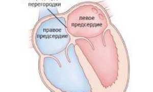 Инсульт операция на голове последствия