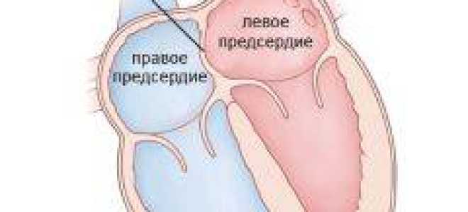 Инсульт операция на голове последствия