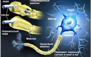 Рассеянный склероз у детей первые признаки