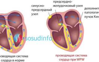 Синдром ввп сердца что это такое
