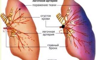 Миксома сердца операция