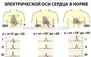 Эос отклонена вправо у ребенка что это