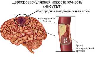 Цвз что это за диагноз