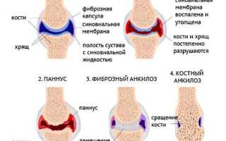 Инфекционный лимфоцитоз