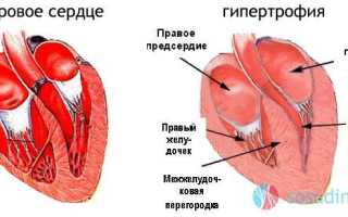 Гипертрофия сердечной мышцы