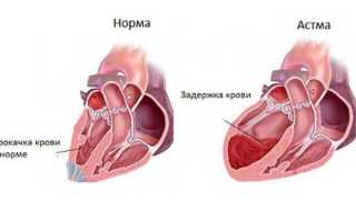 Положение больного при сердечной астме