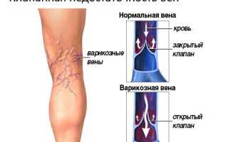 Клапанная недостаточность вен нижних конечностей лечение
