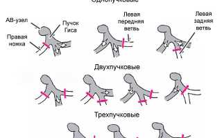 Блокада задней ветви левой ножки пучка гиса