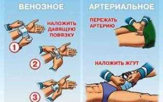 Виды кровотечений и их последствия