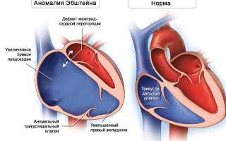 Аномалия эбштейна кардиология