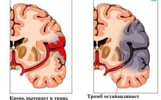 Как начинается инсульт