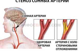 Стеноз правой оса что это
