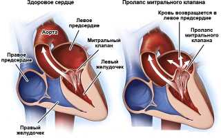 Марс заболевание сердца у подростков