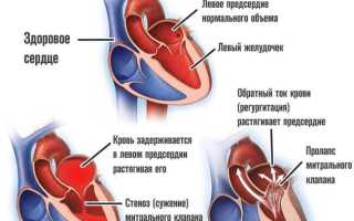 Признаки дилатации левого предсердия