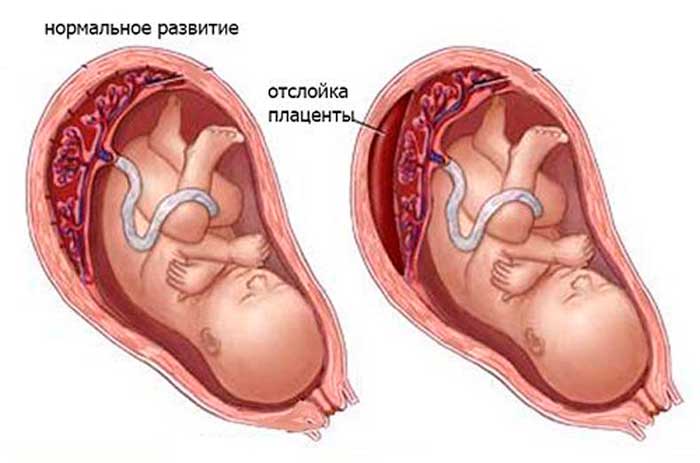 Кровоизлияние в мозг у новорожденных последствия