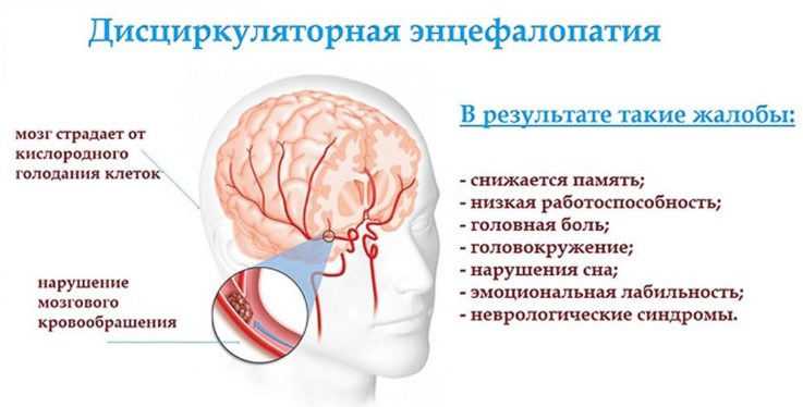 Дисциркуляторная энцефалопатия головного мозга лечение препараты