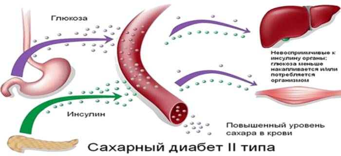 Что такое атеросклеротический кардиосклероз и его лечение