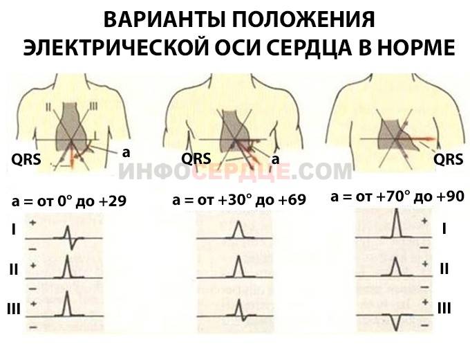 Эос отклонена вправо у ребенка что это