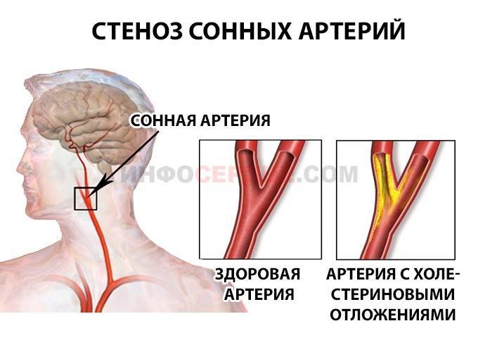 Стеноз правой оса что это