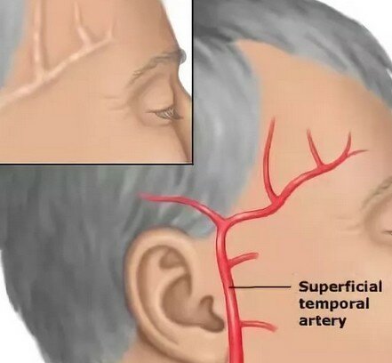 Второй день болит правый висок головы