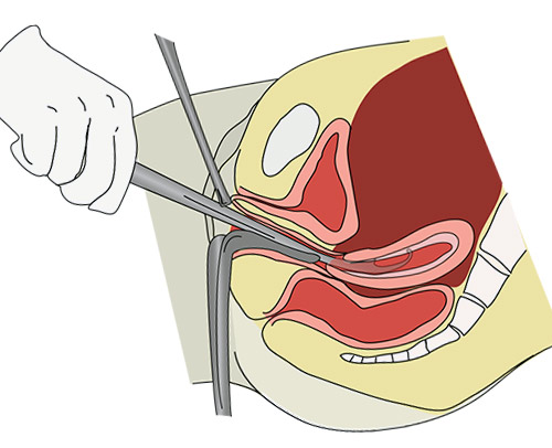 Если после выскабливания болит спина