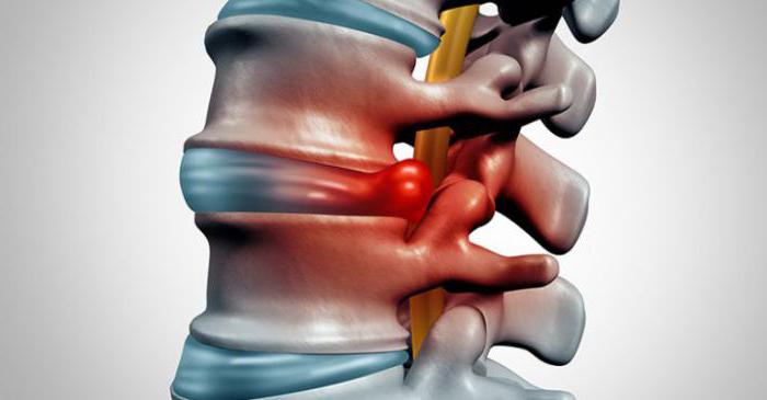 почему болит спина когда встаю с постели