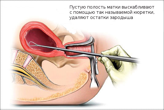 Если после выскабливания болит спина