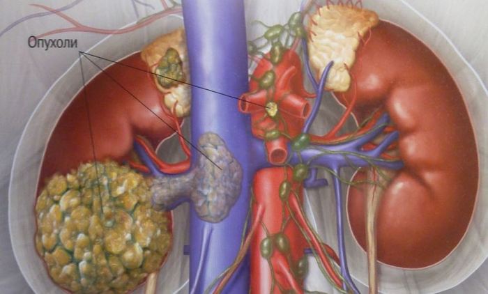 Тупая боль в левом боку сзади может длительное время присутствовать при раке почки болит левый бок сзади в области почки