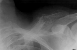 Если болит спина в области ключиц