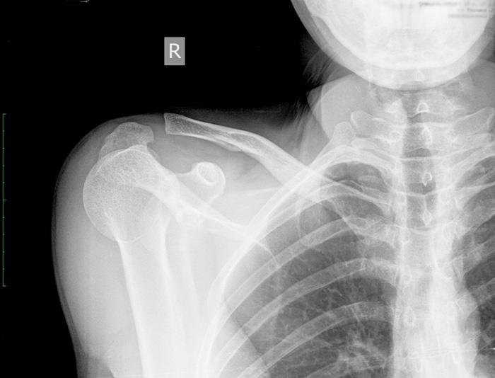 Если болит спина в области ключиц