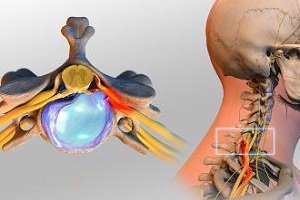 Может ли болеть голова от межпозвоночной грыжи