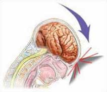 причины боли в руке, остеохондроз шейного отдела позвоночника, боль в руке, боль в шее, боль между лопаток, слабость в руке, причины шаткости при ходьбе, головокружение, причины шума в ушах, вертебробазилярная недостаточность, повреждение межпозвонкового диска