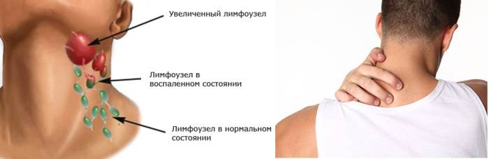 Боль при воспалении шейных лимфоузлов отдает в затылок и верхнюю часть спины