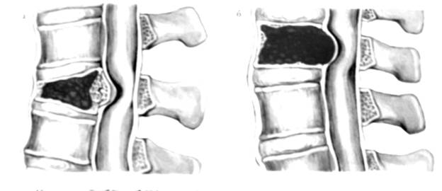 Опухоли позвоночника