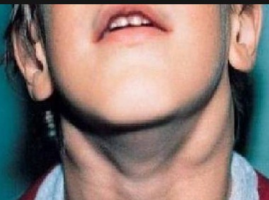 вирусна инфекция горла