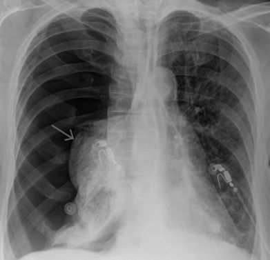 Сильно болит правый бок отдает в спину