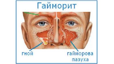 болит вся спина от поясницы до шеи и температура