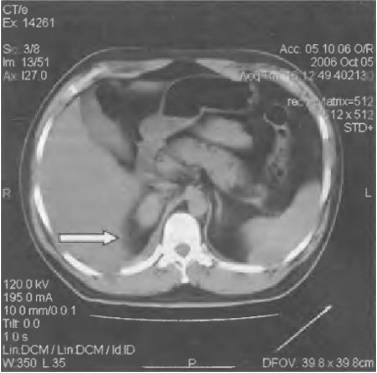 Сильно болит правый бок отдает в спину