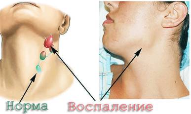 болит вся спина от поясницы до шеи и температура