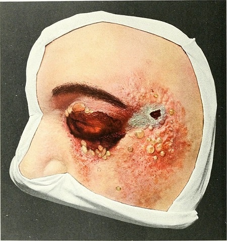 процесс воспаления опасное заболевание