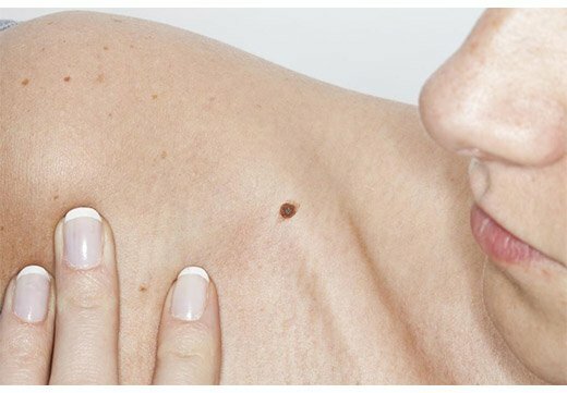 Коричневая родинка