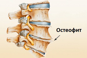 Остеофит Остеофит