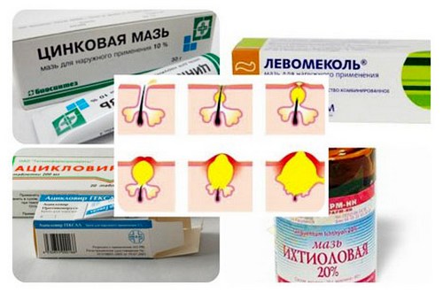 Лечение прыщей на висках