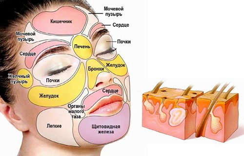 выдавила прыщ на виске болит голова и виски