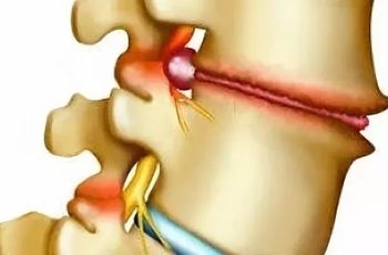 Когда наклоняю голову вниз болит поясница