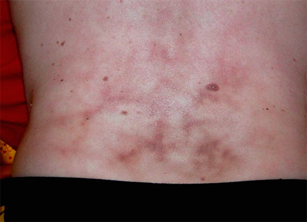 Разрыв нервных окончаний спины