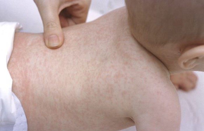 Геморрагическая сыпь при орви Геморрагическая сыпь при орви